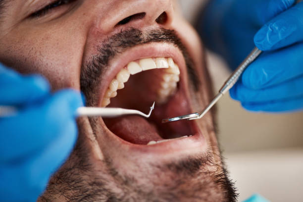 Best Knocked-Out Tooth (Avulsed Tooth) Treatment in San Manuel, AZ